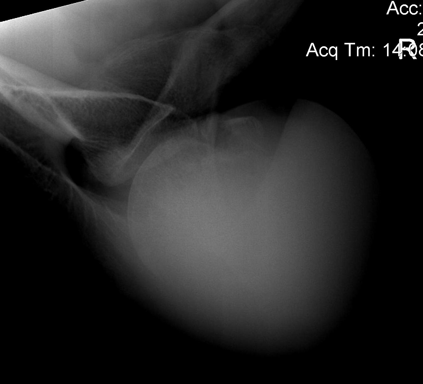 Posterior Shoulder Dislocation Post Reduction Anterior Hill Sachs